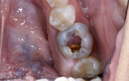 Cara Mengatasi Gigi yang Tumbuh di Gusi